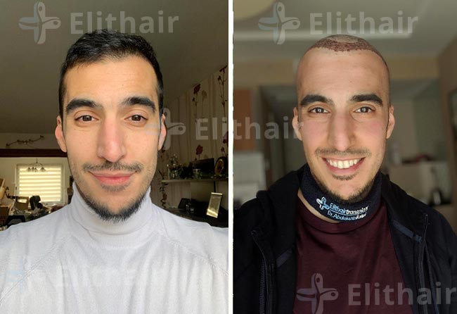 فارس الشمري قبل-وبعد-زراعة-الشعر-في-مركز-اليت-هير