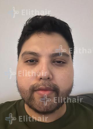 محمد اسكندر بعد-6 شهور-زراعة-اللحية-في-مركز-اليت-هير