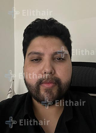 محمد اسكندر بعد -8 شهور-زراعة-اللحية-في-مركز-اليت-هير