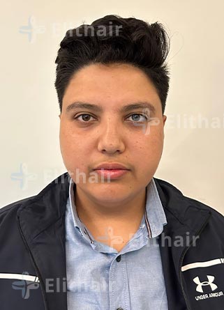 محمد اسكندر قبل-زراعة-اللحية-في-مركز-اليت-هير