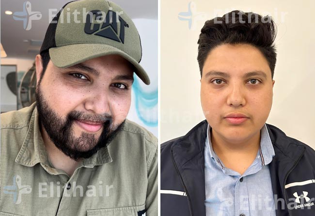 محمد اسكندر قبل-وبعد-زراعة-الشعر-في-مركز-اليت-هير