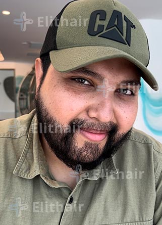 محمد اسكندر نتائج-زراعة-اللحية-في-مركز-اليت-هير