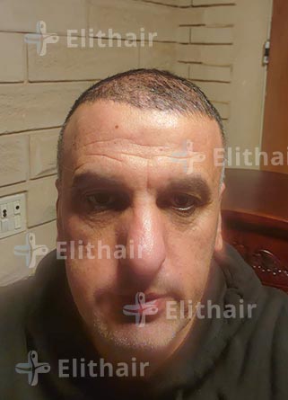 محمد الكسواني بعد -6شهور-زراعة-الشعر-في-مركز-اليت-هير