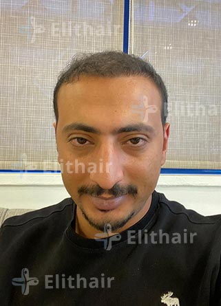 محمد الكسواني بعد -زراعة-الشعر-في-مركز-اليت-هير