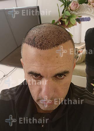 محمد الكسواني بعد شهرين-زراعة-الشعر-في-مركز-اليت-هير