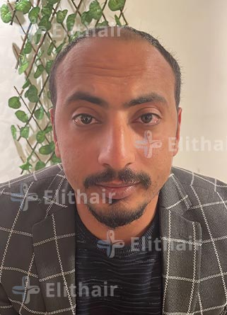 محمد الكسواني قبل-زراعة-الشعر-في-مركز-اليت-هير