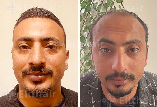 محمد الكسواني قبل-وبعد-زراعة-الشعر-في-مركز-اليت-هير