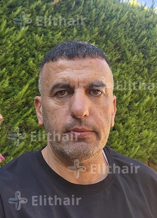 محمد الكسواني نتائج-زراعة-الشعر-في-مركز-اليت-هير .jpg