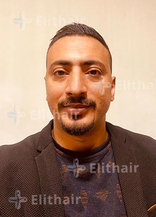 محمد الكسواني نتائج -زراعة-الشعر-في-مركز-اليت-هير
