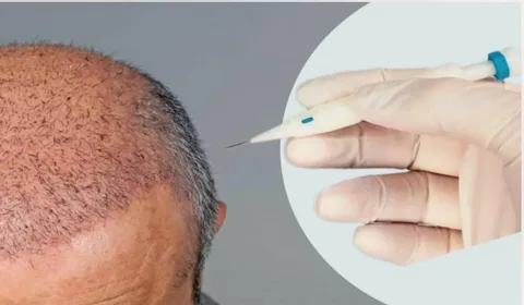 زراعة الشعر بتقنية OSL