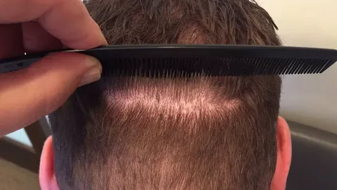 زراعة الشعر في أماكن الحروق والندبات