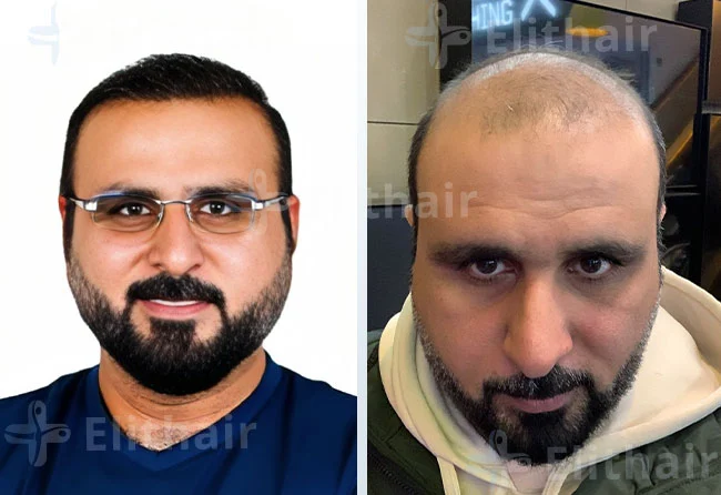 زراعة الشعر في اسطنبول