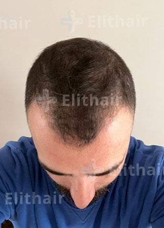 أحمد السيد قبل زراعة الشعر في زراعة الشعر