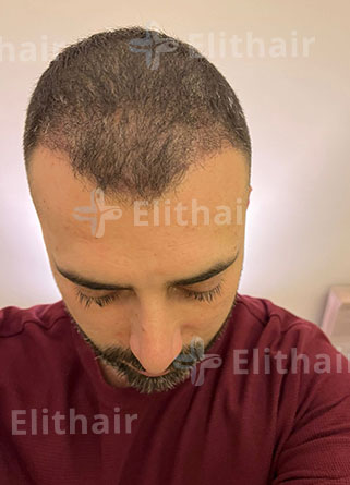 أحمد الصادق بعد 3 شهور من زراعة الشعر في مركز اليت هير