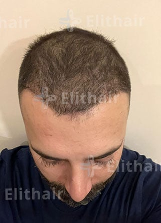 أحمد الصادق بعد 5 شهور من زراعة الشعر في مركز اليت هير