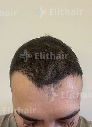 أحمد الصادق بعد 7 شهور من زراعة الشعر في مركز اليت هير