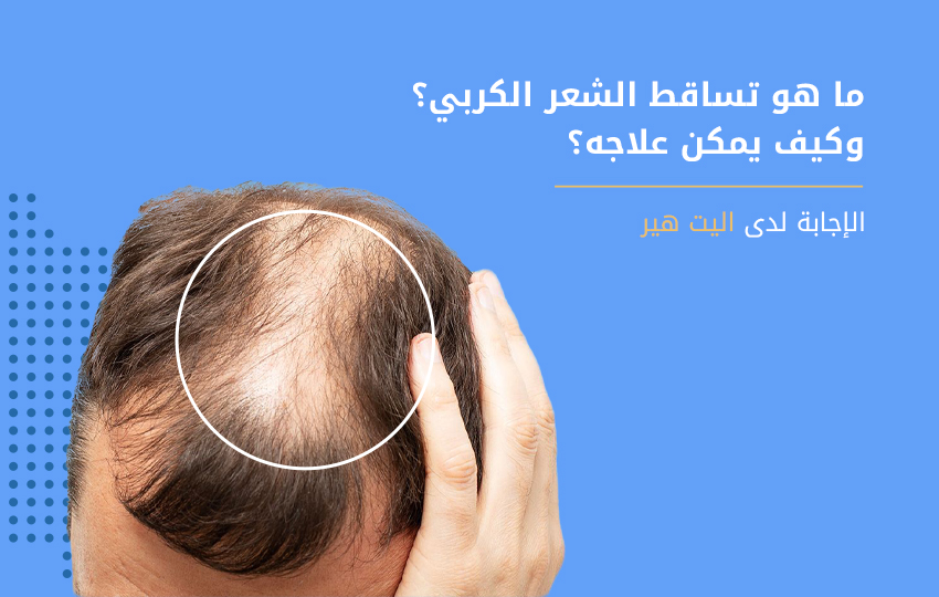 علاج تساقط الشعر الكربي في مركز اليت هير لزراعة الشعر