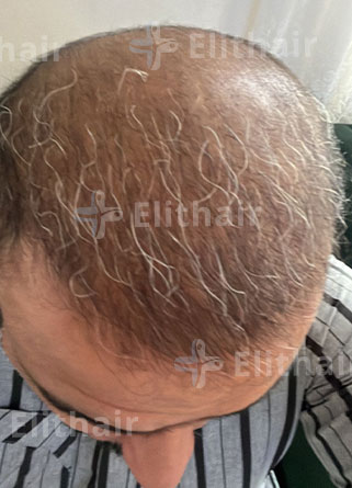 زراعة الشعر لخليل البلوشي بعد 3 شهور