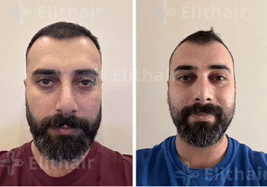 زراعة الشعر لأحمد الصادق - مركز اليت هير لزراعة الشعر