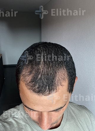 كيمو رفيع لزراعة الشعر بعد 3 شهور