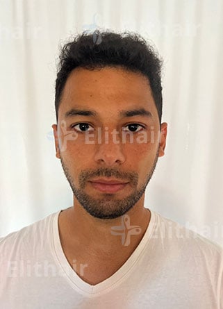 كيمو رفيع لزراعة الشعر بعد 7 شهور