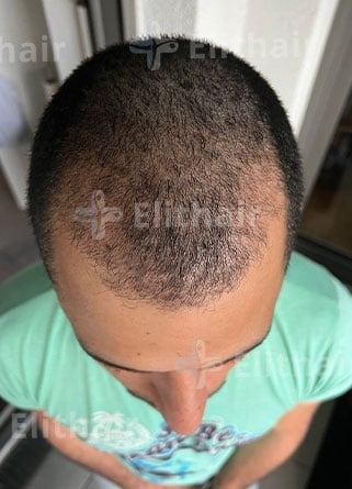 كيمو رفيع لزراعة الشعر بعد شهرين