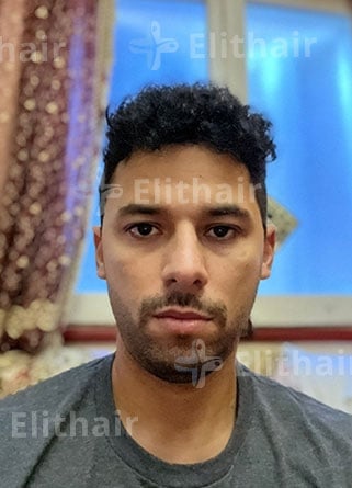 نتائج زراعة الشعر في مركز اليت هير