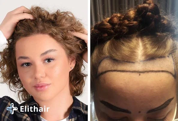 تجارب زراعة الشعر في تركيا
