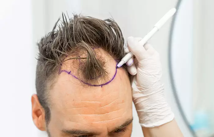 حكم زراعة الشعر في الاسلام