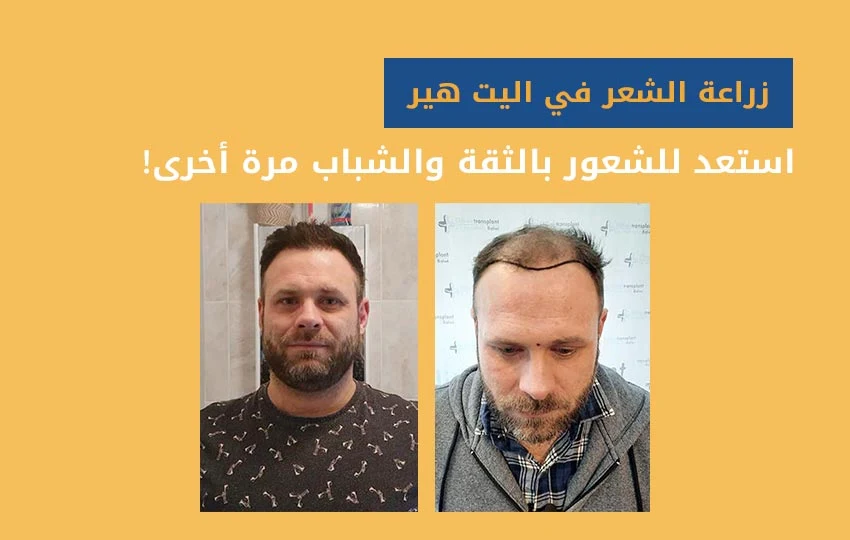 تجارب زراعة الشعر في تركيا