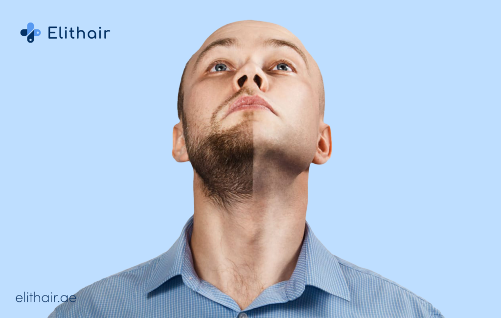 زراعة شعر الذقن - مشفى اليت هير لزراعة الشعر