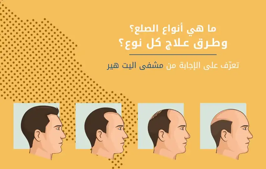 الفرق بين الثعلبة والصلع الوراثي