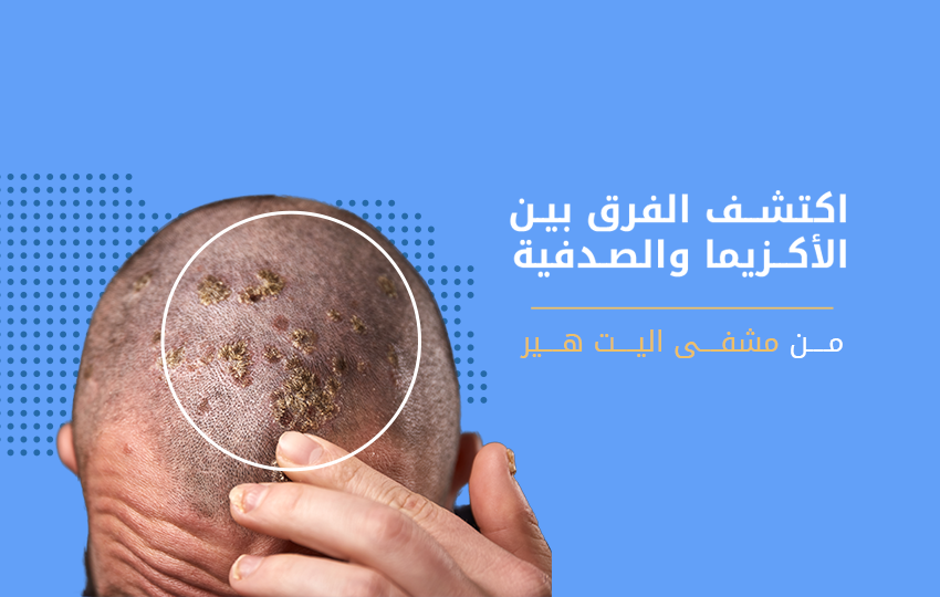 الاكزيما الدهنية وتساقط الشعر