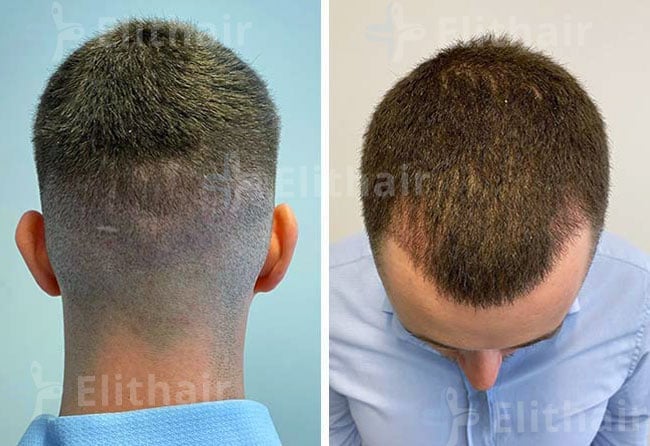 بعد 4 زراعة الشعر في مركز اليت هير