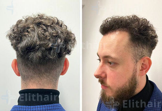 بعد 4.5 شهر زراعة الشعر في مركز اليت هير