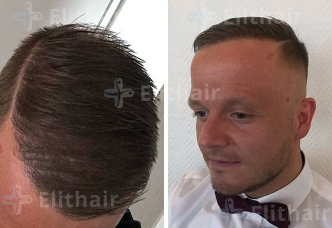 نتائج زراعة الشعر بتقنية DHI في مركز اليت هير