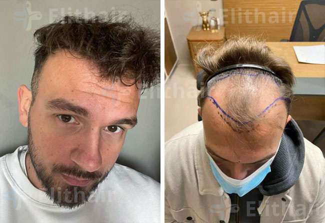 زراعة الشعر قبل وبعد 4500 بصيلة