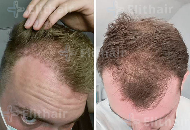 بعد 4 شهور من عملية زراعة الشعر للسيد مارك في مركز اليت هير