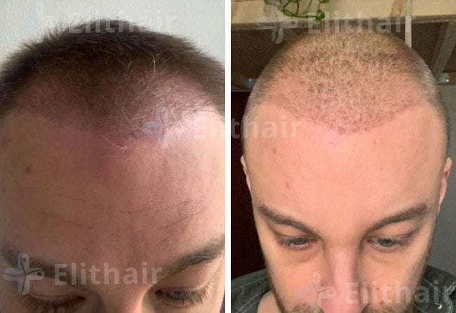 بعد 4 شهور من عملية زراعة الشعر