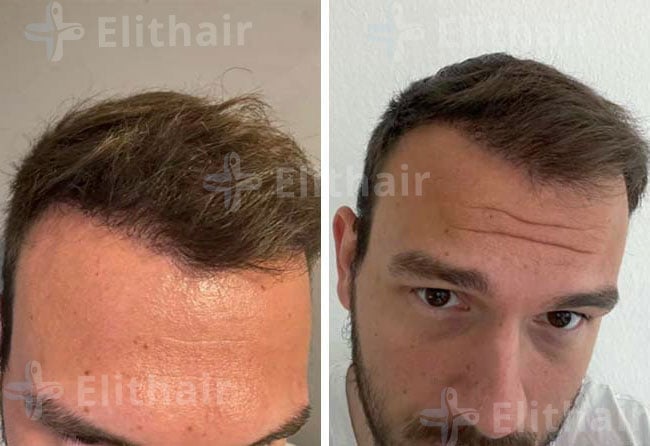 بعد 6 شهور من زراعة الشعر 4500 بصيلة