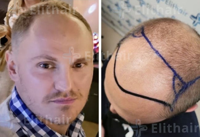 قبل زراعة الشعر للسيد تيم في مركز اليت هير