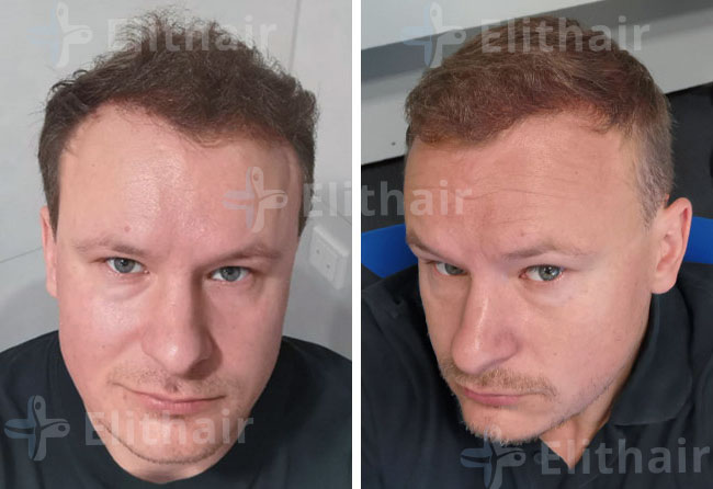 نتائج زراعة الشعر في مركز اليت هير ل 4200 بصيلة