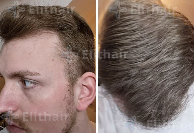 نتائج زراعة الشعر للسيد مارك في مركز اليت هير