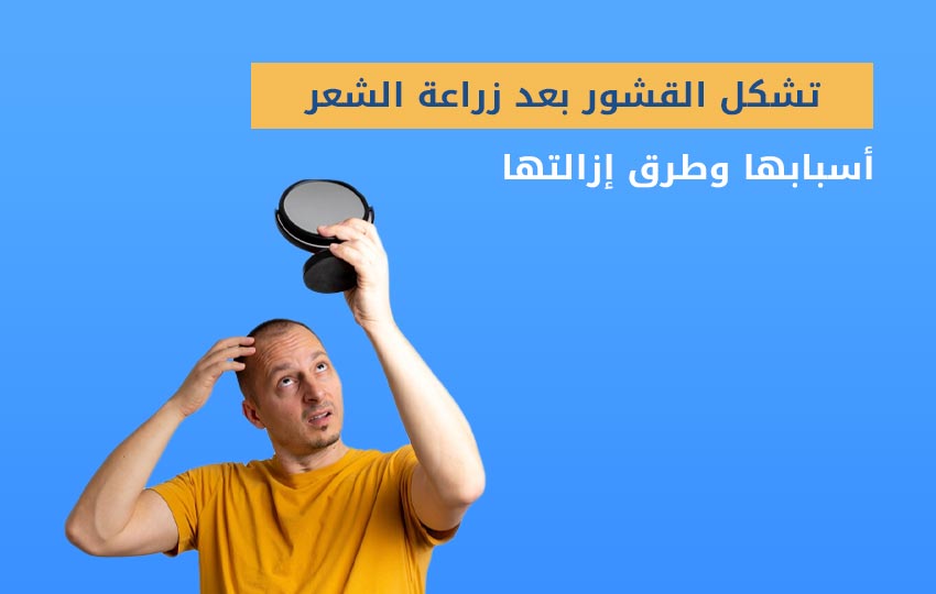 القشور-بعد-زراعة-الشعر-مركز-اليت-هير-لزراعة-الشعر