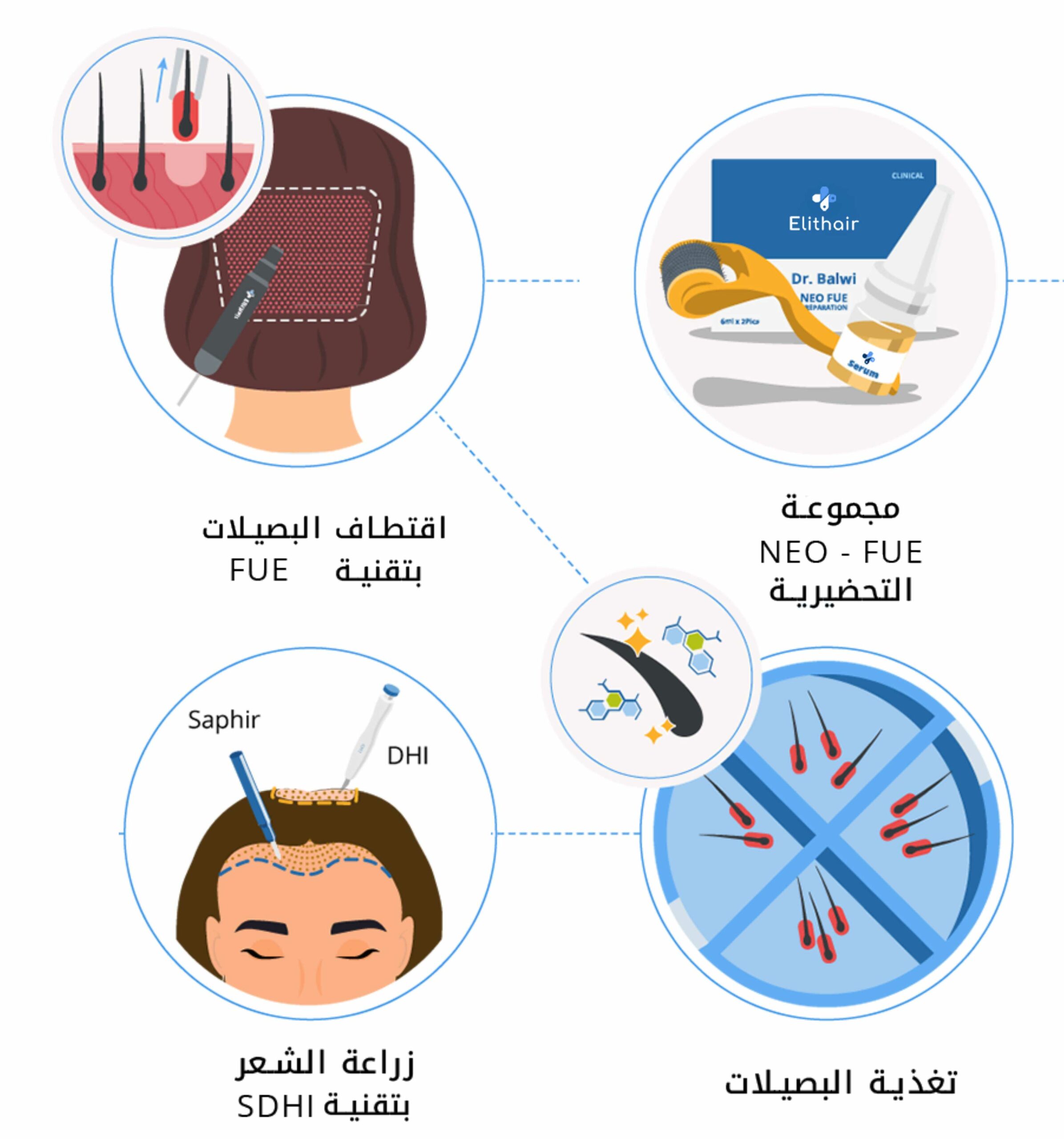 زراعة الشعر تقنية sdhi | مشفى اليت هير