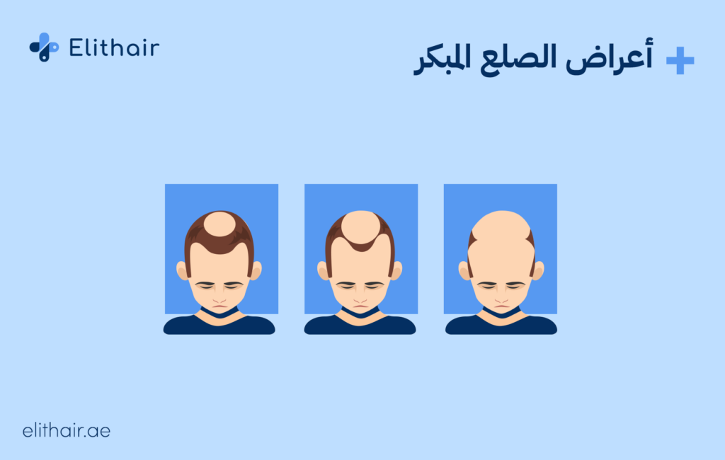 أعراض الصلع المبكر - مشفى اليت هير لزراعة الشعر