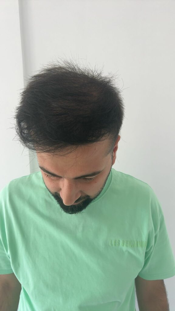 12 شهر بعد زراعة الشعر - مركز اليت هير لزراعة الشعر