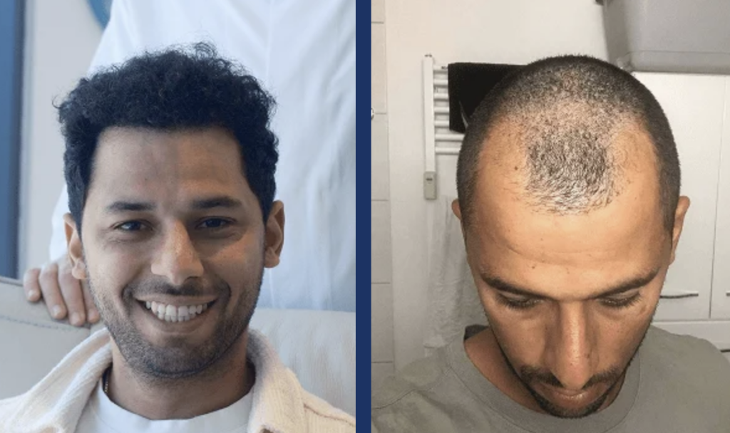 كريم رفيع قبل وبعد زراعة الشعر في اليت هير
