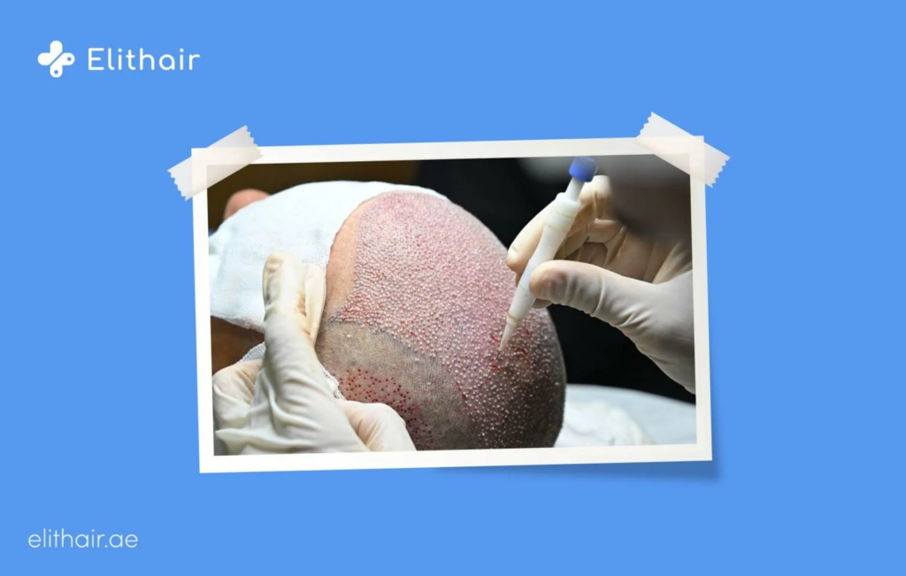 مريض تحت عملية زراعة الشعر في دبي 