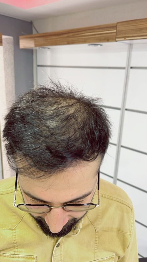 9 أشهر بعد زراعة الشعر - مركز اليت هير لزراعة الشعر